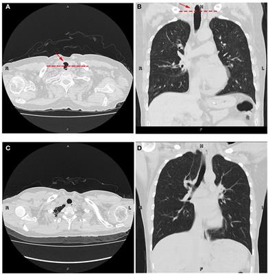 Tracheoesophageal Fistula Caused by Tracheostomy in a Patient with Myasthenia Gravis after a Myasthenic Crisis